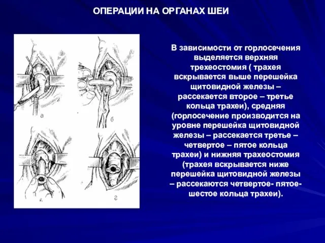 В зависимости от горлосечения выделяется верхняя трехеостомия ( трахея вскрывается выше