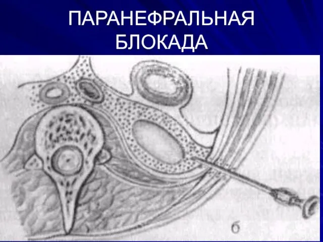 ПАРАНЕФРАЛЬНАЯ БЛОКАДА