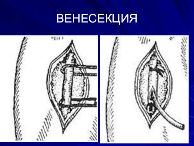 ВЕНЕСЕКЦИЯ