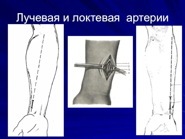 Лучевая и локтевая артерии