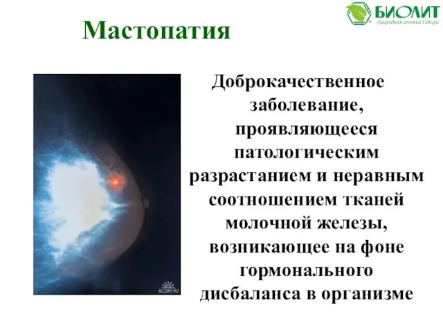 Доброкачественное заболевание, проявляющееся патологическим разрастанием и неравным соотношением тканей молочной железы,