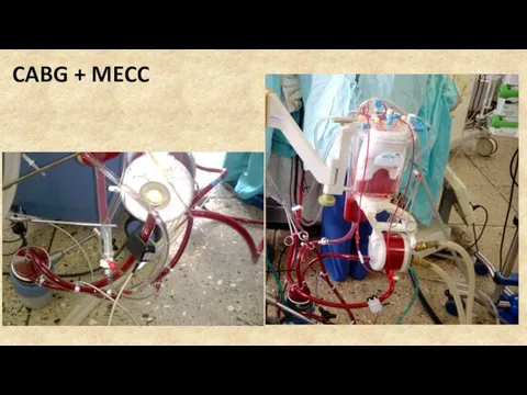 CABG + MECC