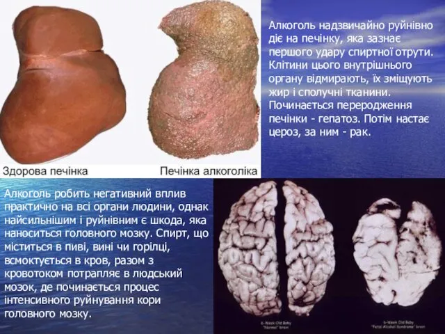 Алкоголь робить негативний вплив практично на всі органи людини, однак найсильнішим