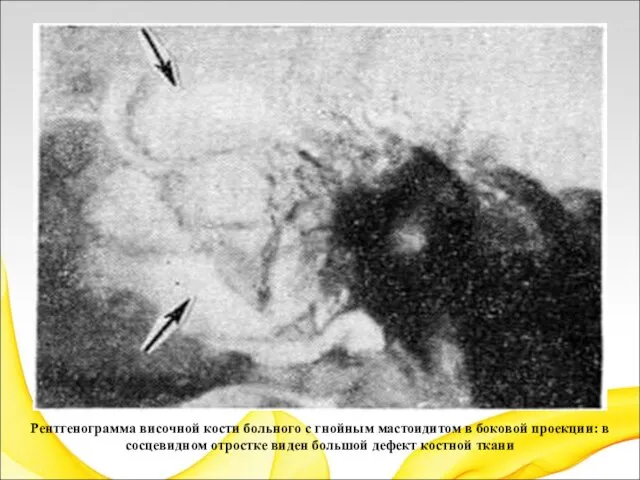 Рентгенограмма височной кости больного с гнойным мастоидитом в боковой проекции: в