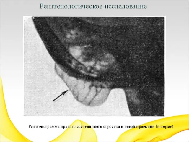 Рентгенологическое исследование Рентгенограмма правого сосцевидного отростка в косой проекции (в норме)