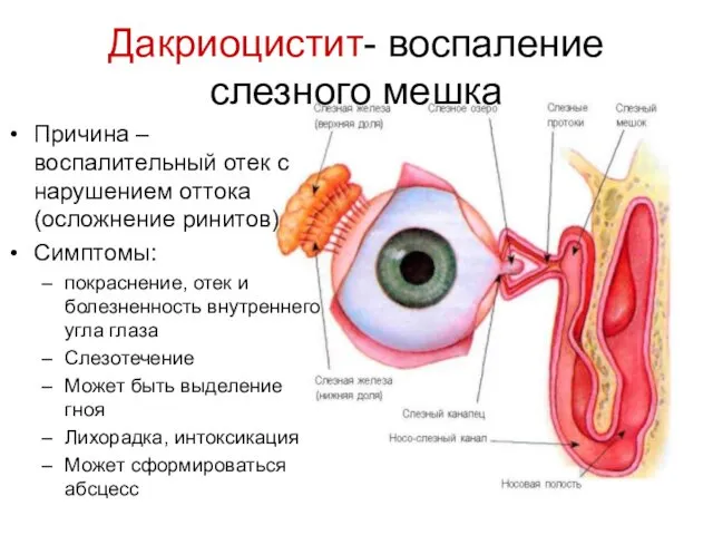 Дакриоцистит- воспаление слезного мешка Причина –воспалительный отек с нарушением оттока (осложнение