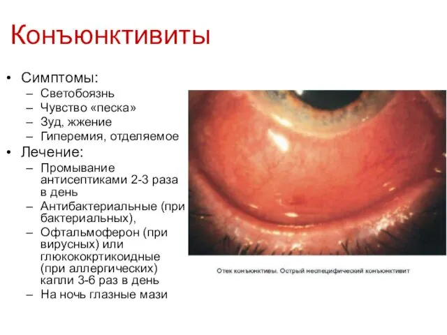 Конъюнктивиты Симптомы: Светобоязнь Чувство «песка» Зуд, жжение Гиперемия, отделяемое Лечение: Промывание