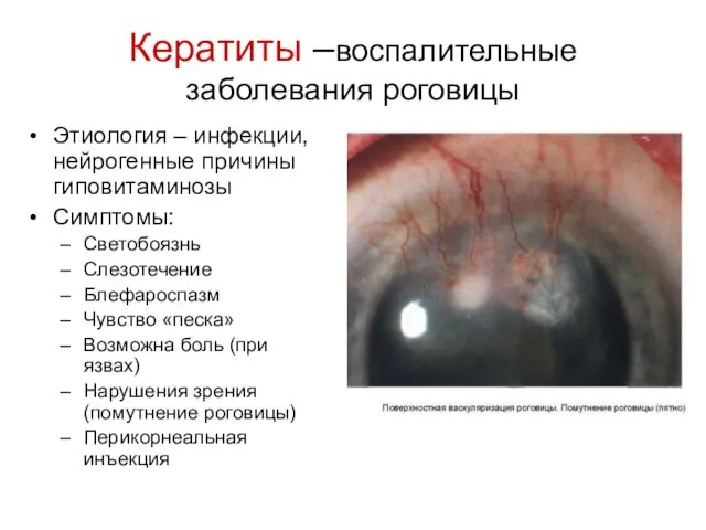 Кератиты –воспалительные заболевания роговицы Этиология – инфекции, нейрогенные причины гиповитаминозы Симптомы: