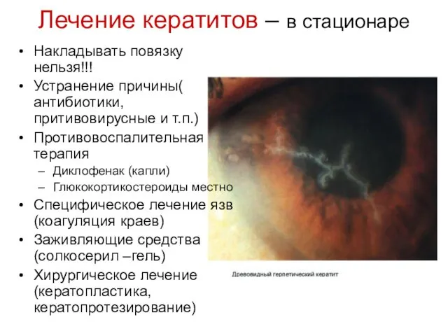 Лечение кератитов – в стационаре Накладывать повязку нельзя!!! Устранение причины( антибиотики,