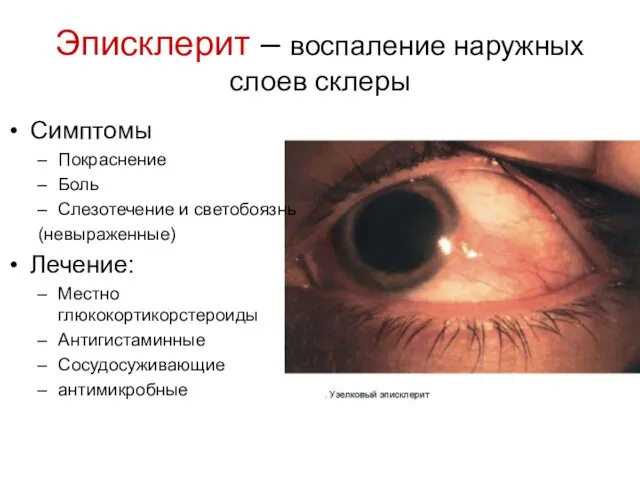 Эписклерит – воспаление наружных слоев склеры Симптомы Покраснение Боль Слезотечение и