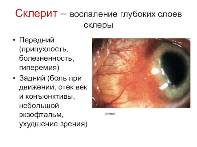 Склерит – воспаление глубоких слоев склеры Передний (припухлость, болезненность, гиперемия) Задний