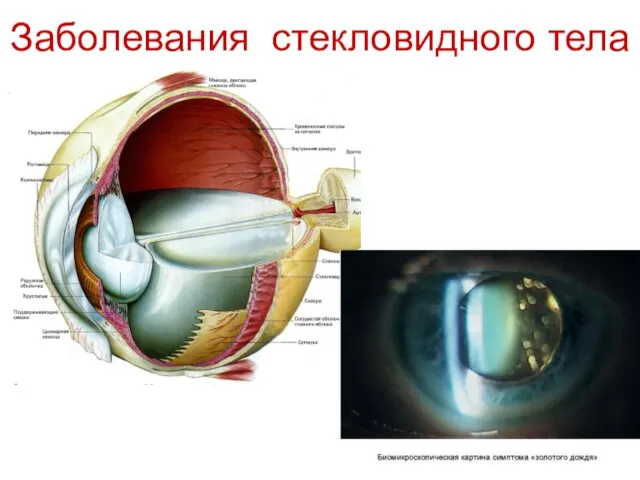 Заболевания стекловидного тела