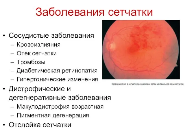 Заболевания сетчатки Сосудистые заболевания Кровоизлияния Отек сетчатки Тромбозы Диабетическая ретинопатия Гипертонические