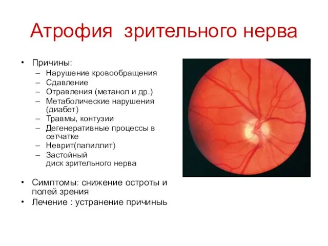 Атрофия зрительного нерва Причины: Нарушение кровообращения Сдавление Отравления (метанол и др.)