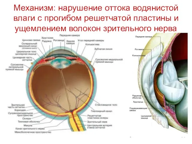 Механизм: нарушение оттока водянистой влаги с прогибом решетчатой пластины и ущемлением волокон зрительного нерва