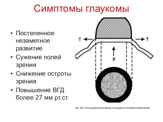 Симптомы глаукомы Постепенное незаметное развитие Сужение полей зрения Снижение остроты зрения