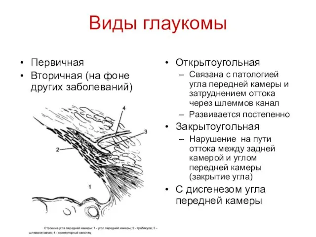 Виды глаукомы Первичная Вторичная (на фоне других заболеваний) Открытоугольная Связана с