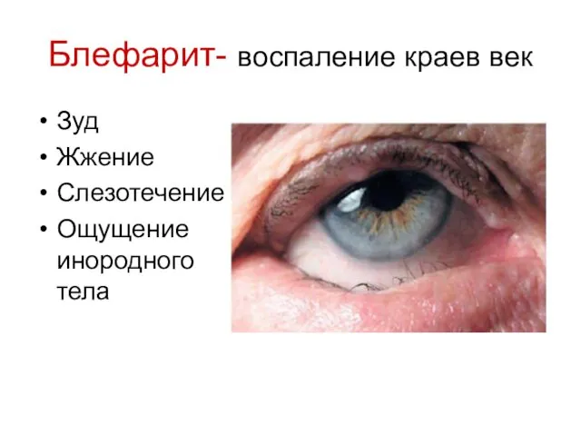 Блефарит- воспаление краев век Зуд Жжение Слезотечение Ощущение инородного тела