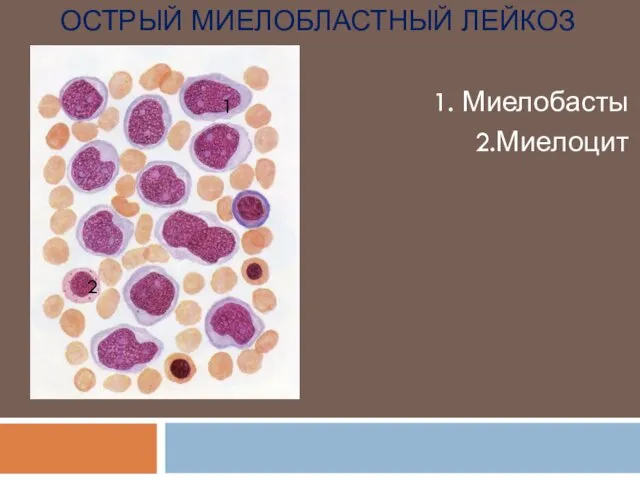 ОСТРЫЙ МИЕЛОБЛАСТНЫЙ ЛЕЙКОЗ 1. Миелобасты 2.Миелоцит 1 2