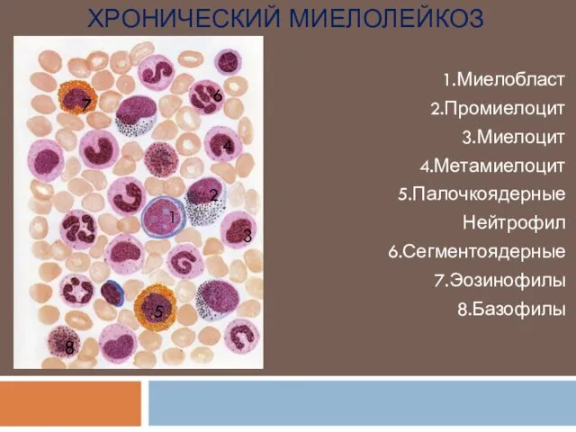 ХРОНИЧЕСКИЙ МИЕЛОЛЕЙКОЗ 1.Миелобласт 2.Промиелоцит 3.Миелоцит 4.Метамиелоцит 5.Палочкоядерные Нейтрофил 6.Сегментоядерные 7.Эозинофилы 8.Базофилы