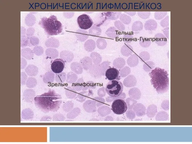 ХРОНИЧЕСКИЙ ЛИФМОЛЕЙКОЗ