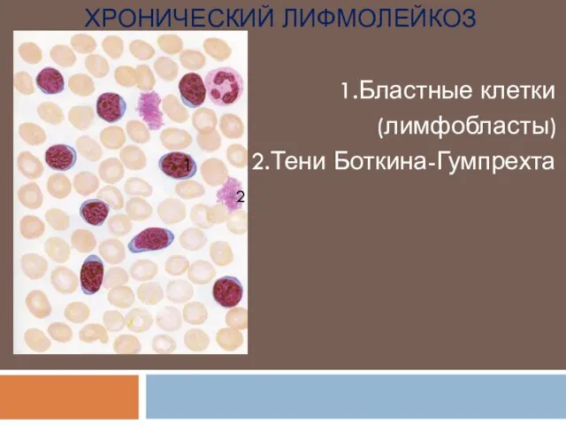 ХРОНИЧЕСКИЙ ЛИФМОЛЕЙКОЗ 1.Бластные клетки (лимфобласты) 2.Тени Боткина-Гумпрехта 1 2