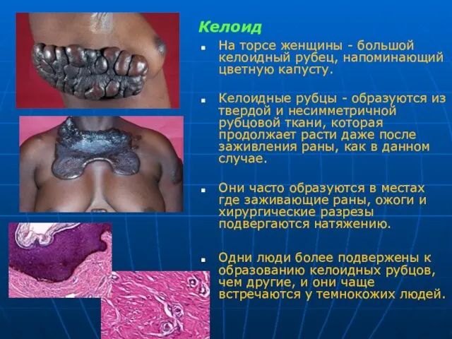 Келоид На торсе женщины - большой келоидный рубец, напоминающий цветную капусту.