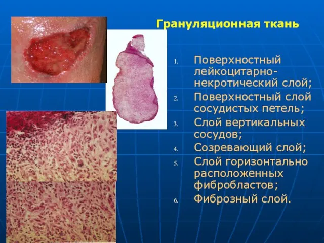 Грануляционная ткань Поверхностный лейкоцитарно-некротический слой; Поверхностный слой сосудистых петель; Слой вертикальных