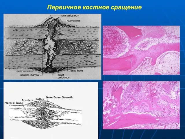 Первичное костное сращение