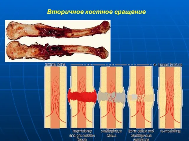 Вторичное костное сращение