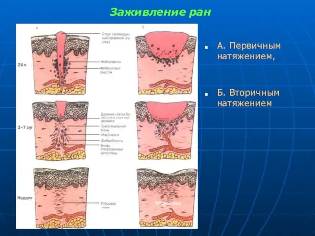 Заживление ран А. Первичным натяжением, Б. Вторичным натяжением