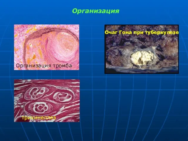 Организация Организация тромба трихинеллез Очаг Гона при туберкулезе