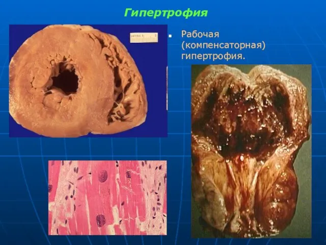 Гипертрофия Рабочая (компенсаторная) гипертрофия.