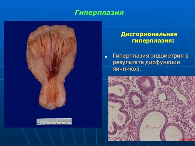 Гиперплазия Дисгормональная гиперплазия: Гиперплазия эндометрия в результате дисфункции яичников.