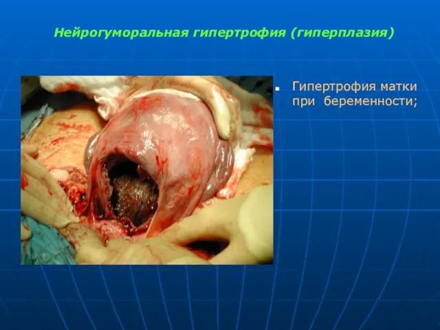 Нейрогуморальная гипертрофия (гиперплазия) Гипертрофия матки при беременности;