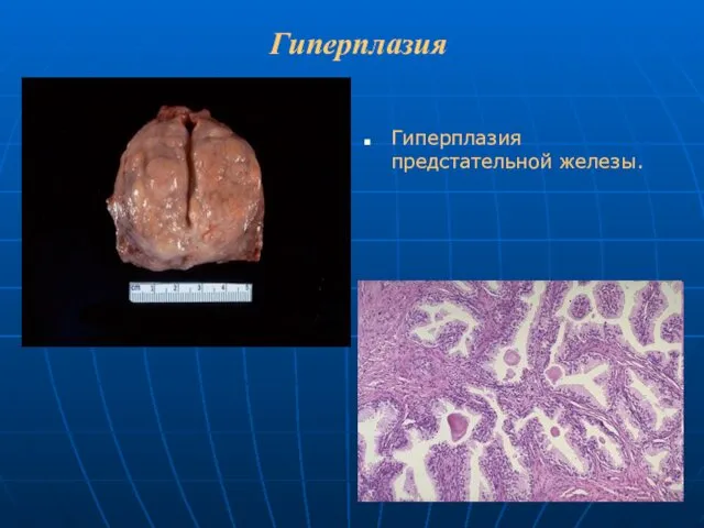 Гиперплазия Гиперплазия предстательной железы.