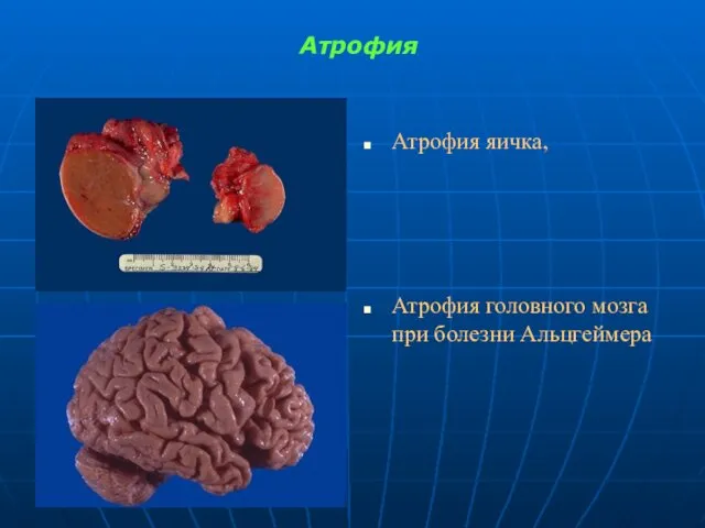 Атрофия Атрофия яичка, Атрофия головного мозга при болезни Альцгеймера