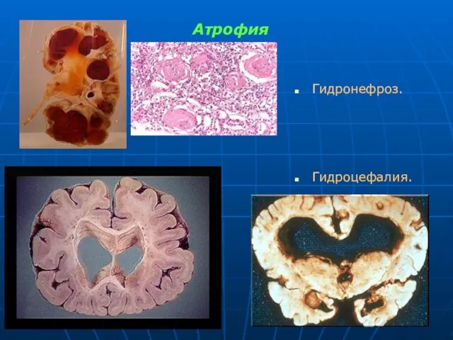 Атрофия Гидронефроз. Гидроцефалия.
