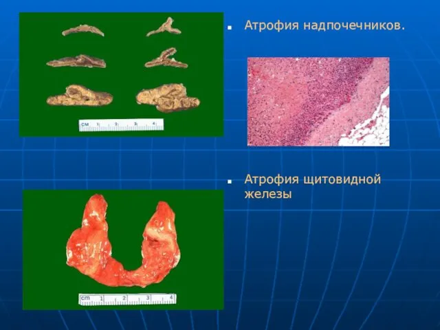 Атрофия надпочечников. Атрофия щитовидной железы