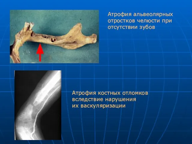 Атрофия альвеолярных отростков челюсти при отсутствии зубов Атрофия костных отломков вследствие нарушения их васкуляризации