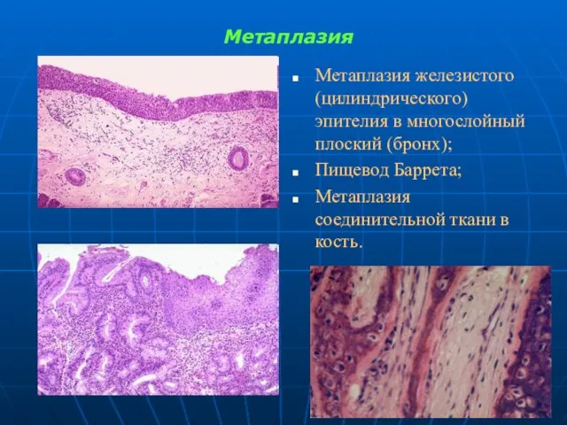 Метаплазия Метаплазия железистого (цилиндрического) эпителия в многослойный плоский (бронх); Пищевод Баррета; Метаплазия соединительной ткани в кость.