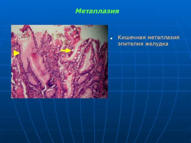 Метаплазия Кишечная метаплазия эпителия желудка