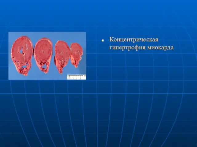 Концентрическая гипертрофия миокарда