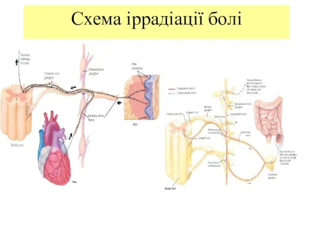 Схема іррадіації болі