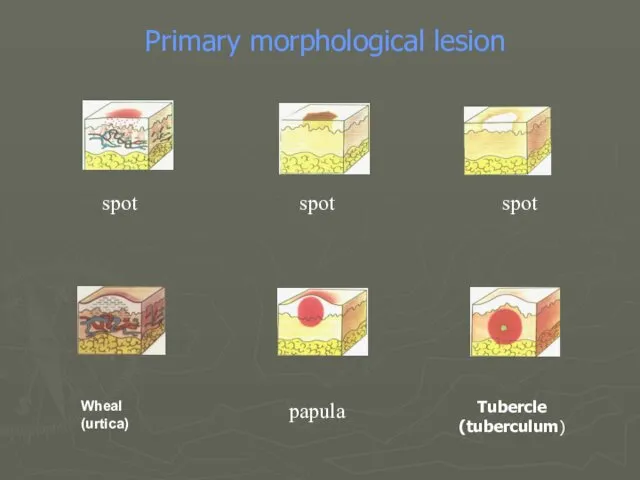 spot spot spot Tubercle (tuberculum) Wheal (urtica) Primary morphological lesion papula