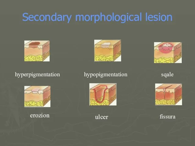 Secondary morphological lesion hyperpigmentation hypopigmentation sqale erozion ulcer fissura