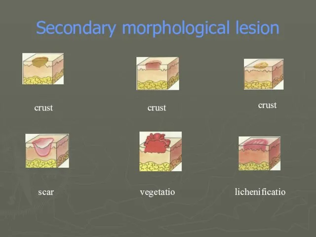 Secondary morphological lesion crust crust crust scar vegetatio lichenificatio