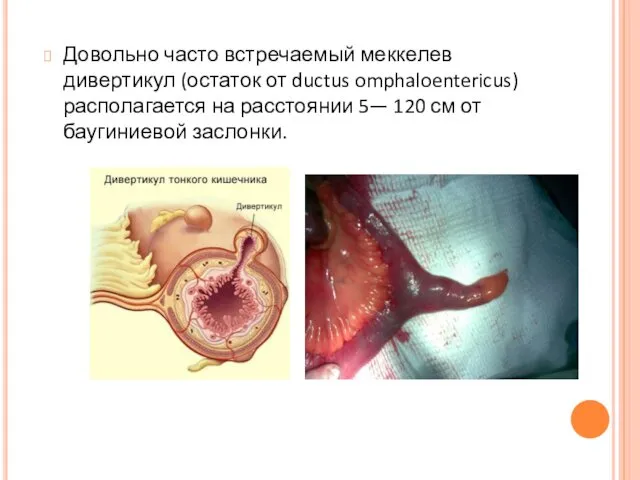 Довольно часто встречаемый меккелев дивертикул (остаток от ductus omphaloentericus) располагается на