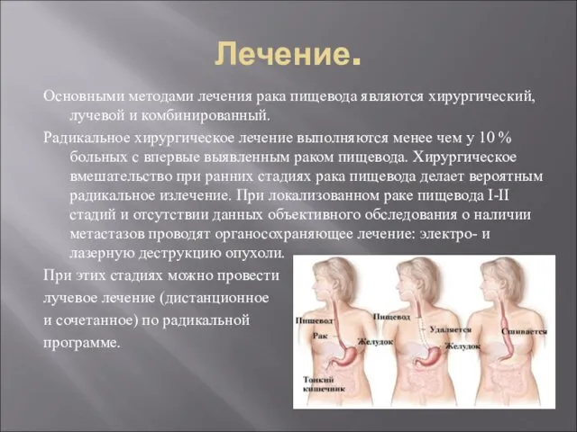 Лечение. Основными методами лечения рака пищевода являются хирургический, лучевой и комбинированный.