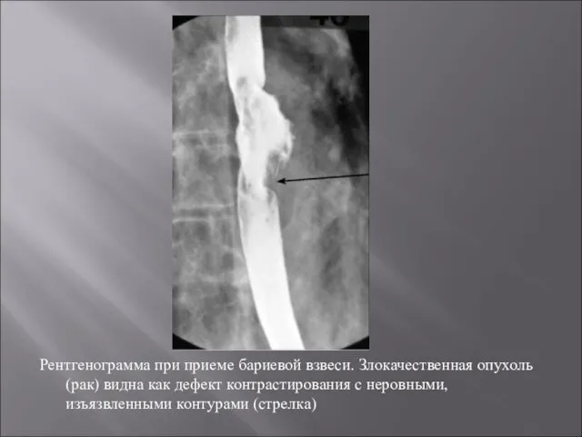 Рентгенограмма при приеме бариевой взвеси. Злокачественная опухоль (рак) видна как дефект